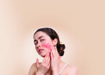 SLE – Systemsicher Lupus Erythematodes