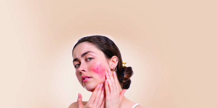 SLE – Systemsicher Lupus Erythematodes